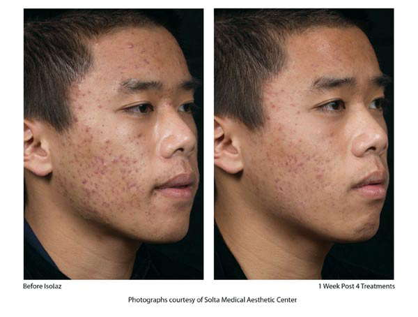 before and after acne treatments