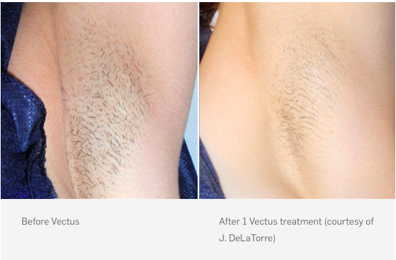 Before and after laser hair removal