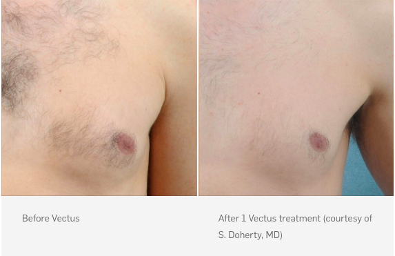 Before and after laser hair removal