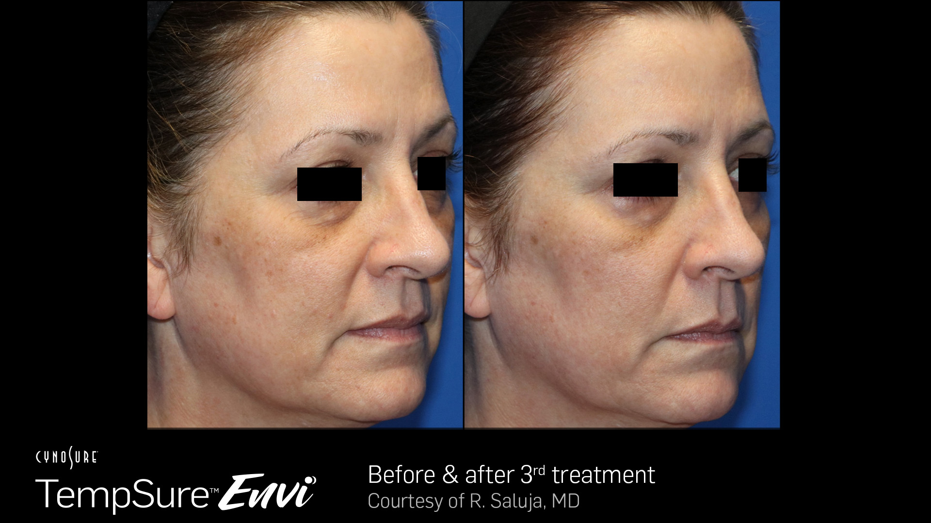 Before and after results for TempSure Envi