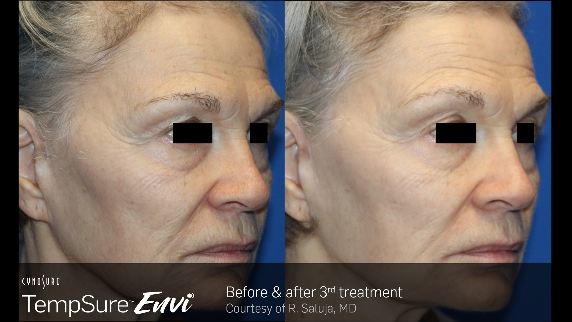 Before and after results for TempSure Envi