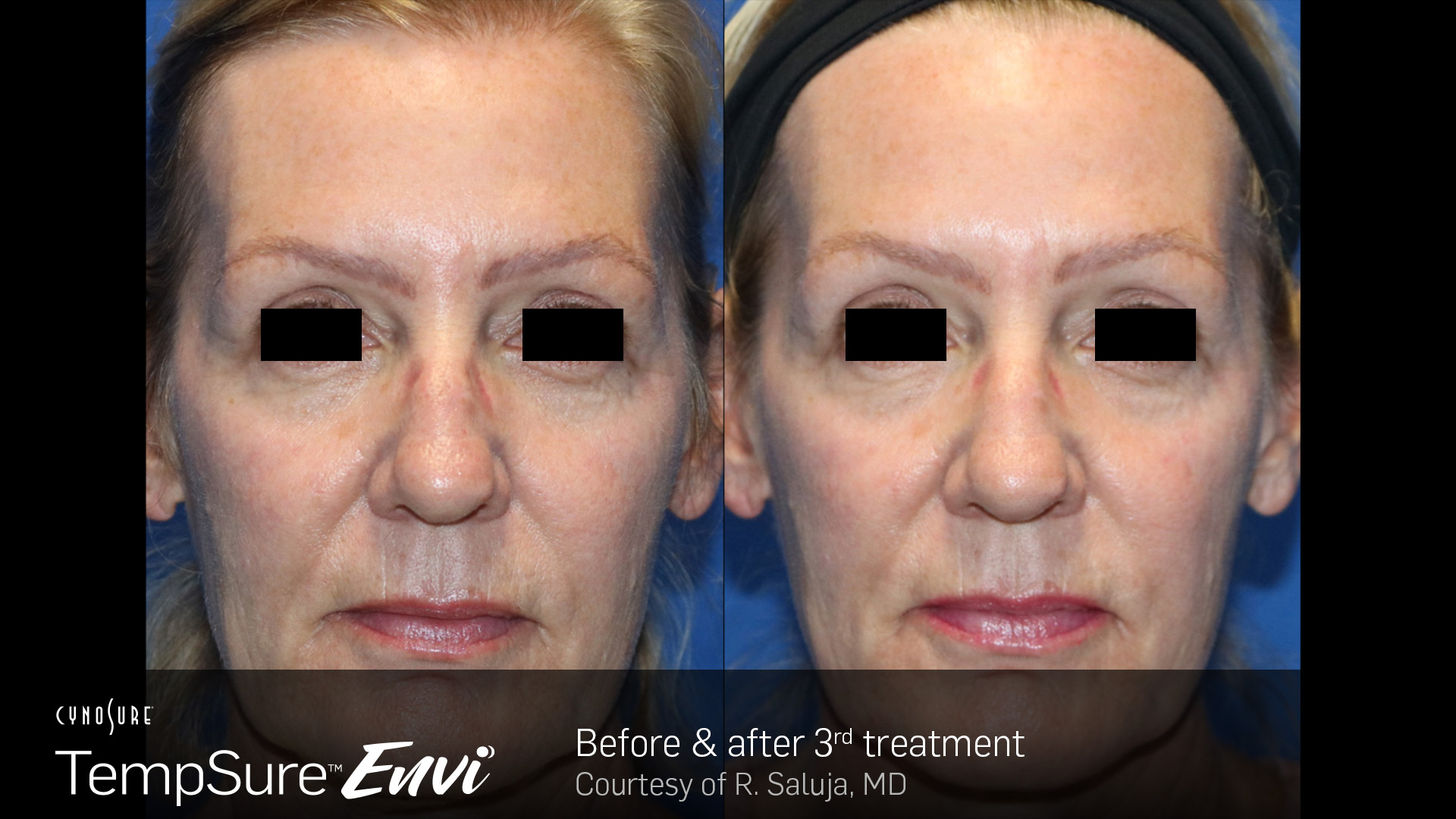 Before and after results for TempSure Envi